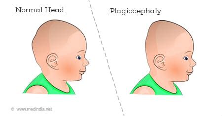 Common Conditions In Kids: Plagiocephaly/Flat Head Syndrome Victoria Sports And Rehabilitation ...