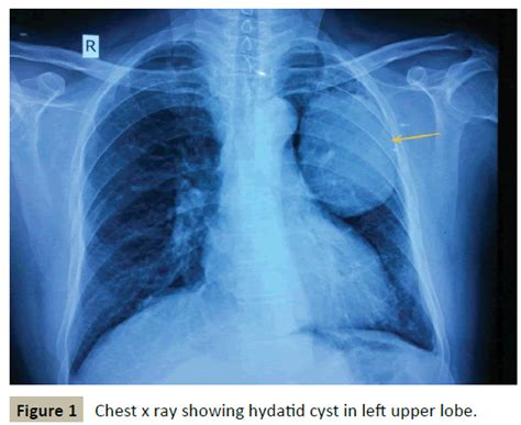 Uncommon Hydatid Cyst in Lung