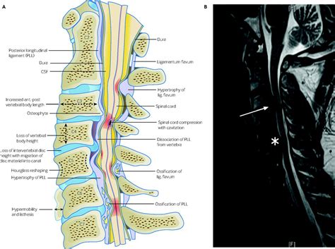 Degenerative cervical myelopathy | The BMJ