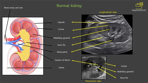 Normal Kidney Ultrasound