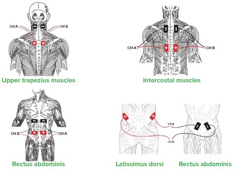 Improving Activation of Accessory Respiratory Muscles with NMES