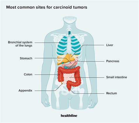 Carcinoid Tumors: Symptoms, Diagnosis, Treatment, and Outlook