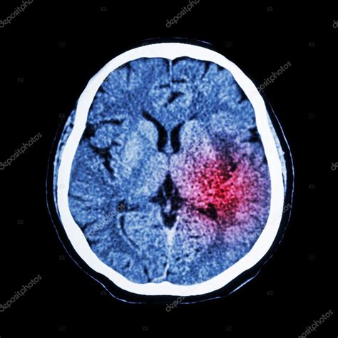 La tomografía computarizada del cerebro muestra derrame cerebral isquémico o derrame cerebral ...