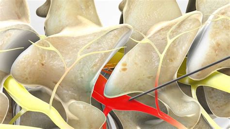 Blog | Selected Nerve Root Injections (SNRI)