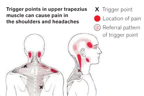 Aching Neck And Shoulders: Are they Muscle Knots?