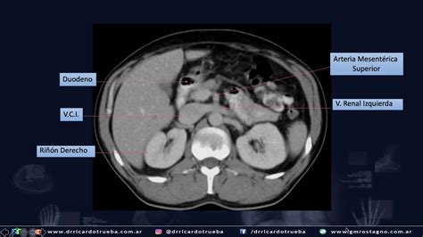 TOMOGRAFIA AXIAL BASICA DE ABDOMEN Y PELVIS - YouTube