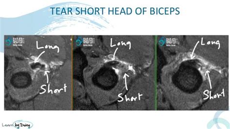 Distal Biceps Tendon: Double Trouble - Radedasia