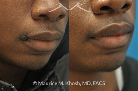 New York Facial Plastic Surgery Skin Laceration Repair / Mole removal Before and After Pictures