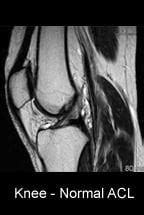 MRI Images - torn ACL and normal ACL