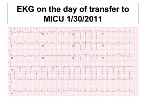 Systolic anterior motion of mitral valve - SAM