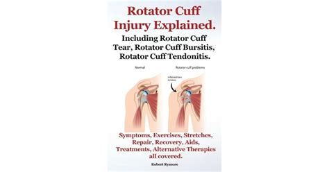 Rotator Cuff Injury Explained. Including Rotator Cuff Tear, Rotator ...