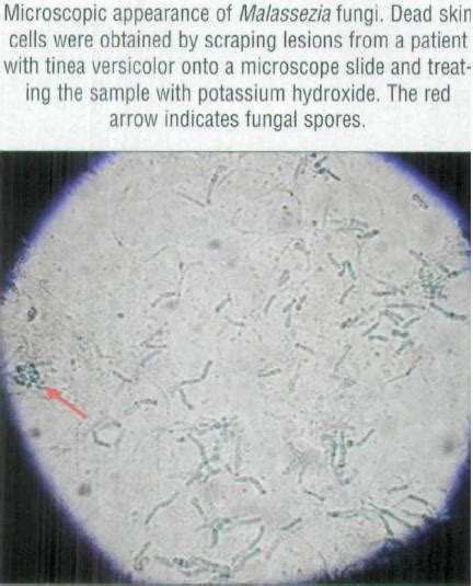 Tinea Cruris Clinical Presentation: History, Physical Examination, Causes - kienitvc.ac.ke