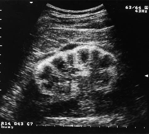 Renal ultrasonography, coronal plane. A significant increase in cortical echogenicity is seen ...