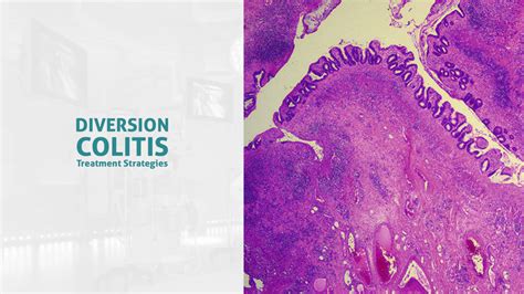 Diversion Colitis - Ulcerative Colitis Causes And Symptoms / Diversion colitis can be easily ...