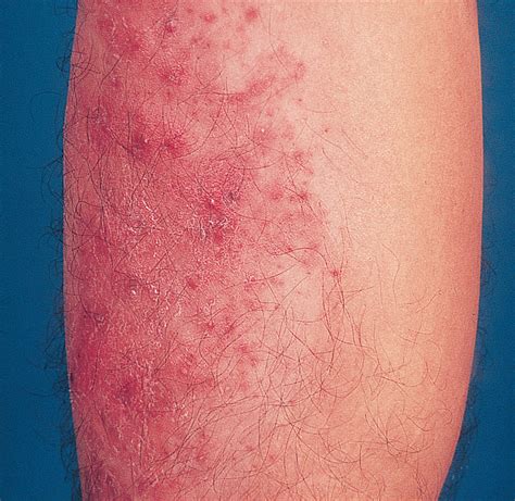 Unusual Papular Lesions in a Healthy Man | Dermatology | JAMA Dermatology | The JAMA Network