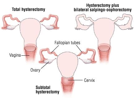 Patient Basics: Hysterectomy | 2 Minute Medicine