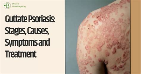 Guttate Psoriasis: Stages, Causes, Symptoms and Treatment - Bharat Homeopathy