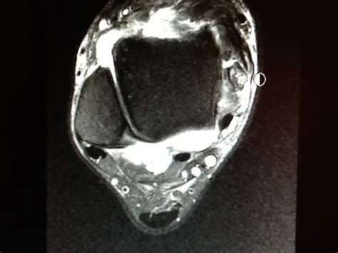 Foot and Ankle Problems By Dr. Richard Blake: Posterior Tibial Tendon Tear: MRI images