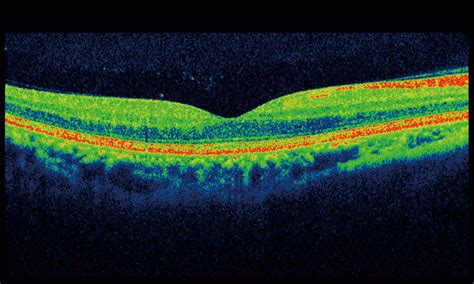 Taank Adds OCT Exam to Eye Care Services | Cambridge Opticians | Taank Optometrists