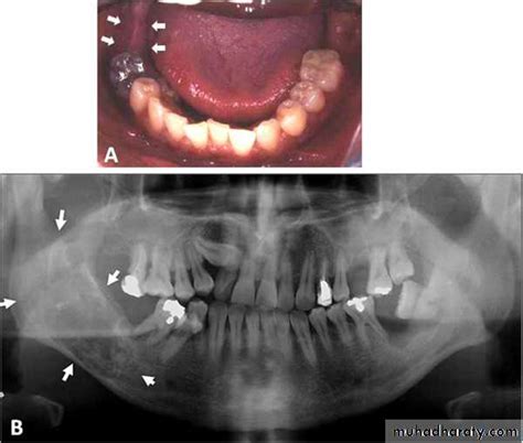 odontogenic tumors pptx - د.عطاالله فتحي - Muhadharaty