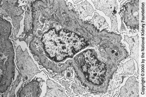 Thin Basement Membrane Disease Complications - Openbasement