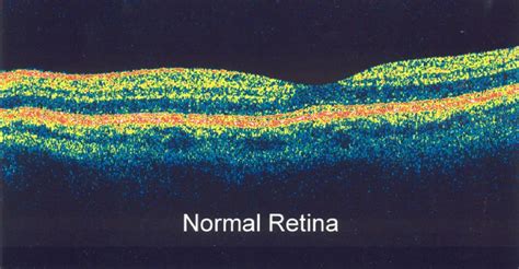 What Is Optical Coherence Tomography? - American Academy of Ophthalmology