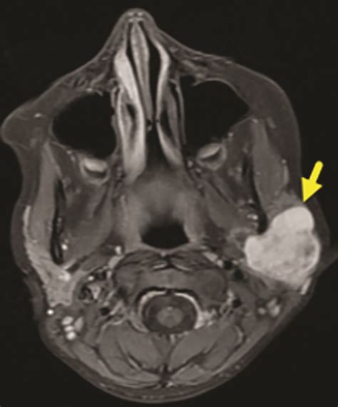 Pleomorphic Adenoma of the Parotid Gland • APPLIED RADIOLOGY