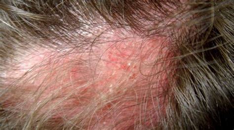 Alopecia and systemic Lupus erythematosus: correlations not to be ...