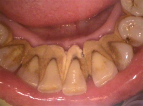 Case of the week: Calculus with clinical photo – Dr. G's Toothpix