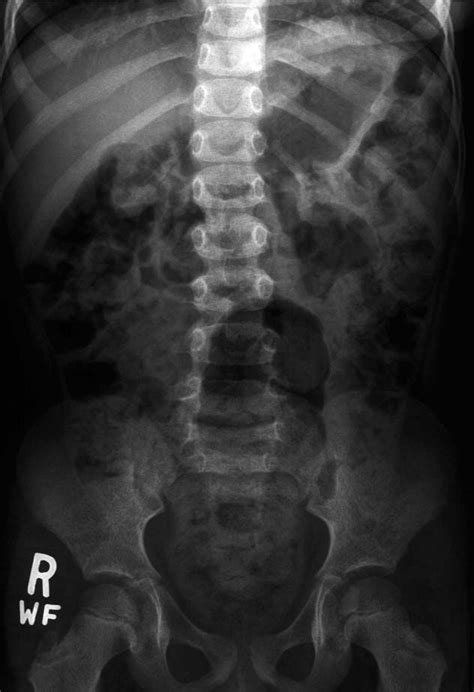 Plain abdominal radiograph showing fecal loading of the large bowel and... | Download Scientific ...