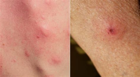 Is that a Mosquito or Tick Bite? How to Tell These Bug Bites Apart