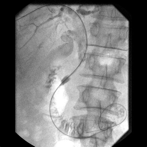 Biliary interventions: Case 2 — Albany IR