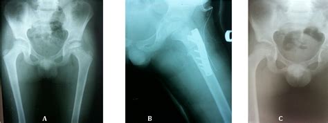 Figure 1 from Clinical outcome of femoral osteotomy in patients with legg-calve´-perthes disease ...