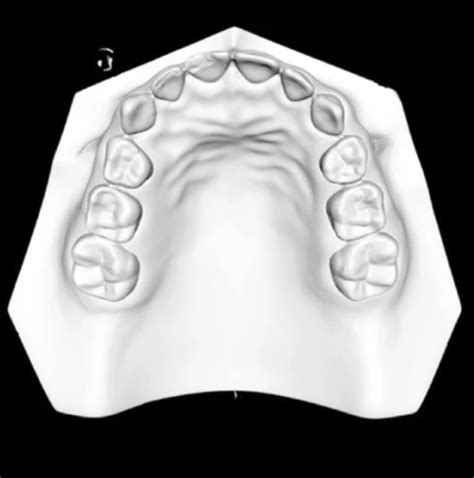 BMC Oral Health Releases a Study on CAD/CAM Use for Pediatric Space Maintainer Removal — Digital ...