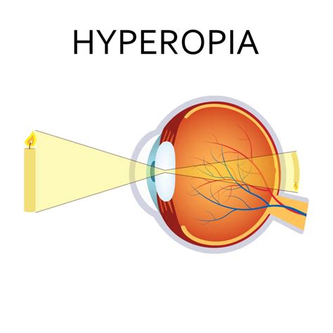 Hyperopia Symptoms & Treatments