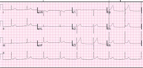 Dr. Smith's ECG Blog: This ECG, recorded in triage, was shown to me immediately, with no other ...