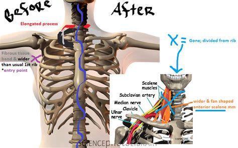 Reckless' Rants and Raves: I had TOS surgery...rib resection surgery