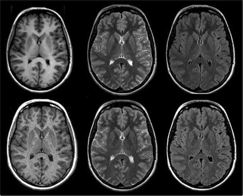 From left to right: T1, T2, and FLAIR-weighted conventional (top row)... | Download Scientific ...