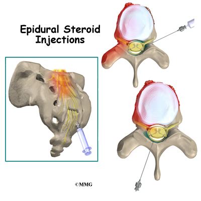 Epidural Steroid Injections - eOrthopod.com