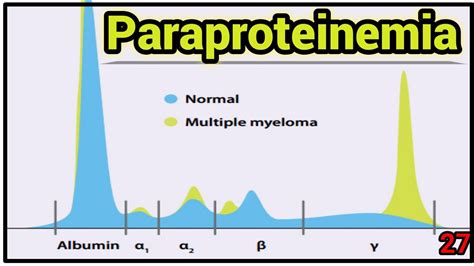 Blood || Paraproteinemia & Multiple Myeloma || Lecture 27 - YouTube