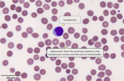 Spherocytes - LearnHaem | Haematology Made Simple