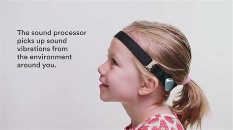 BAHA Vs Cochlear Implants: Understanding The Difference