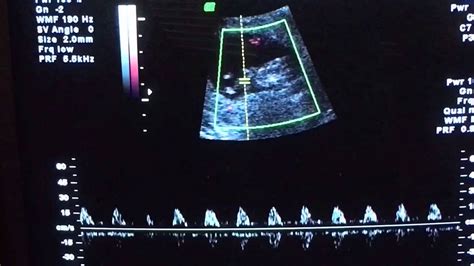 11 week ultrasound, Doppler, heartbeat - YouTube