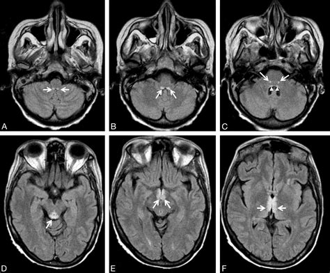 Wernickes Encephalopathy