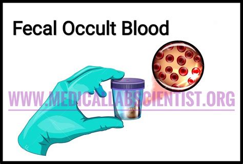 stool occult blood test procedure Archives - Medical Laboratory Scientist - MLS