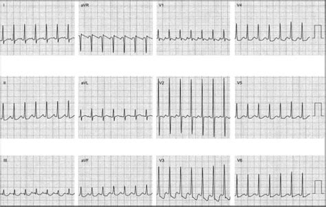 Atrial Tachycardia: Diagnosis - The Cardiology Advisor