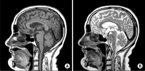 Normal Sagittal Brain Mri