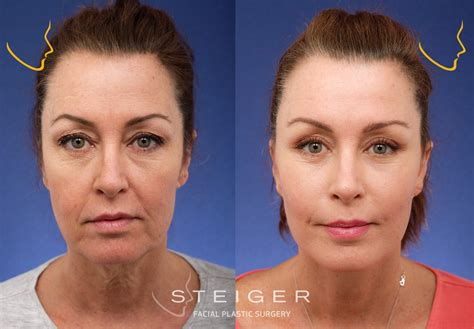 Facelift Before and After Photos | Deep Plane Facelift