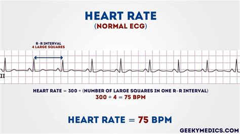 Pin on Ekg interpretation