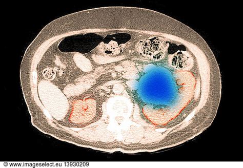 CT scan of a kidney cyst CT scan of a kidney cyst,computed axial tomography,computed tomography ...